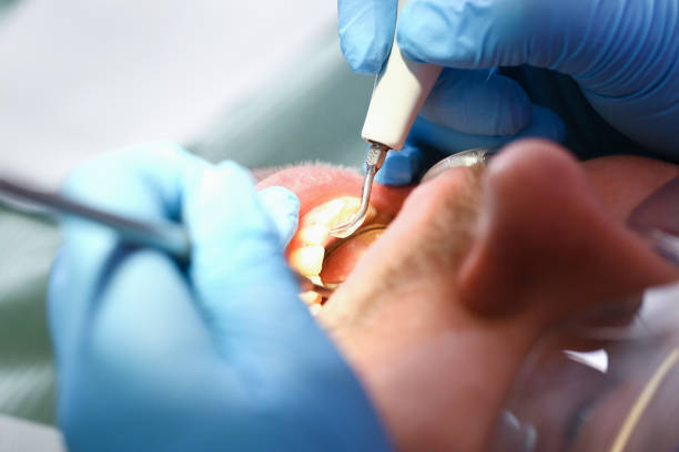 Teeth Whitening in UT